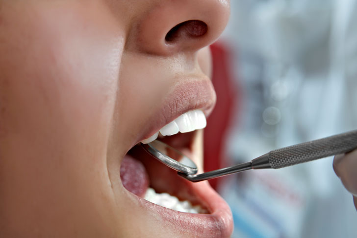 как вылечить грибок полости рта