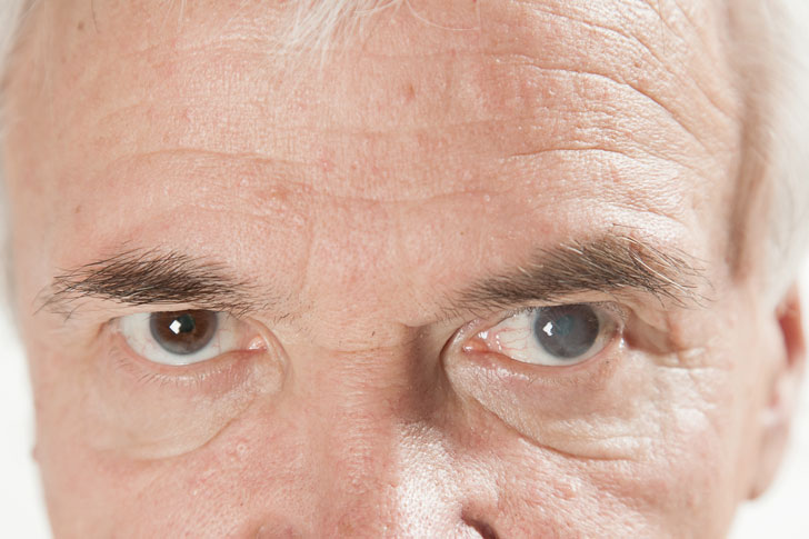 катаракта левого глаза