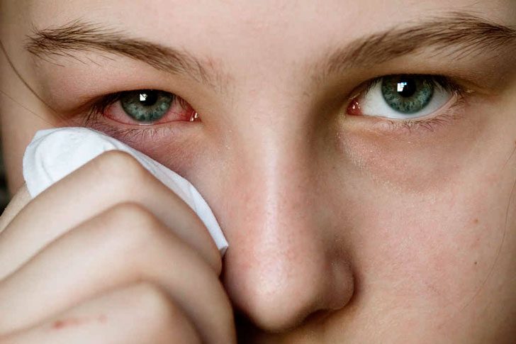 симптомы глазного герпеса